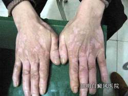 诊断白癜风的要点有哪些