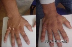 白癜风好转的症状表现